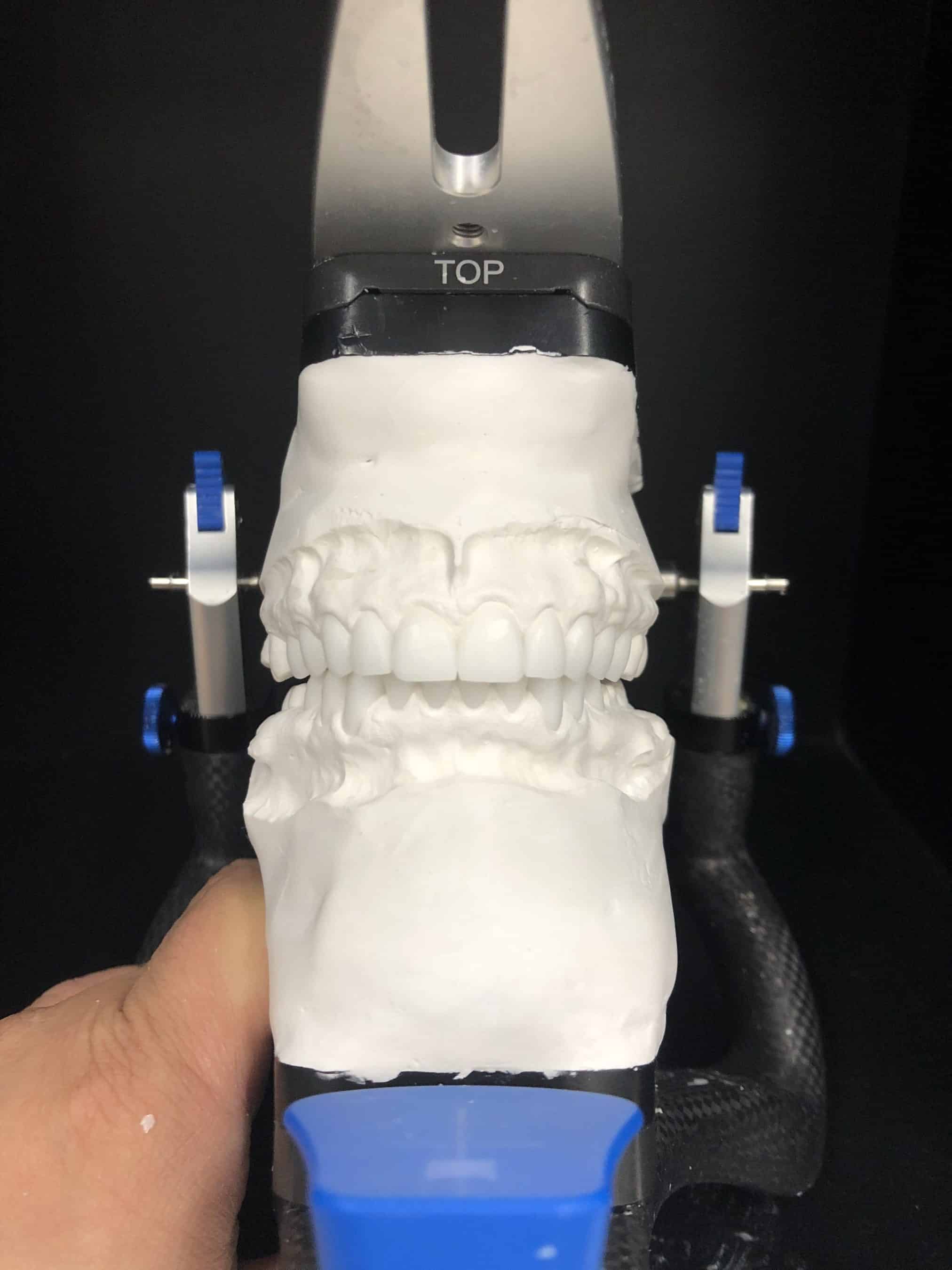 Cosmetic veneers waxup 5 Dental Lab image 2