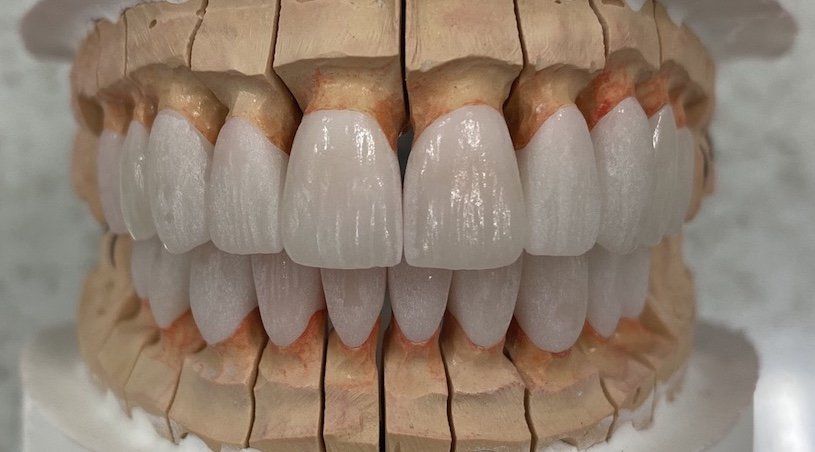 Cosmetic zirconia crowns and bridges