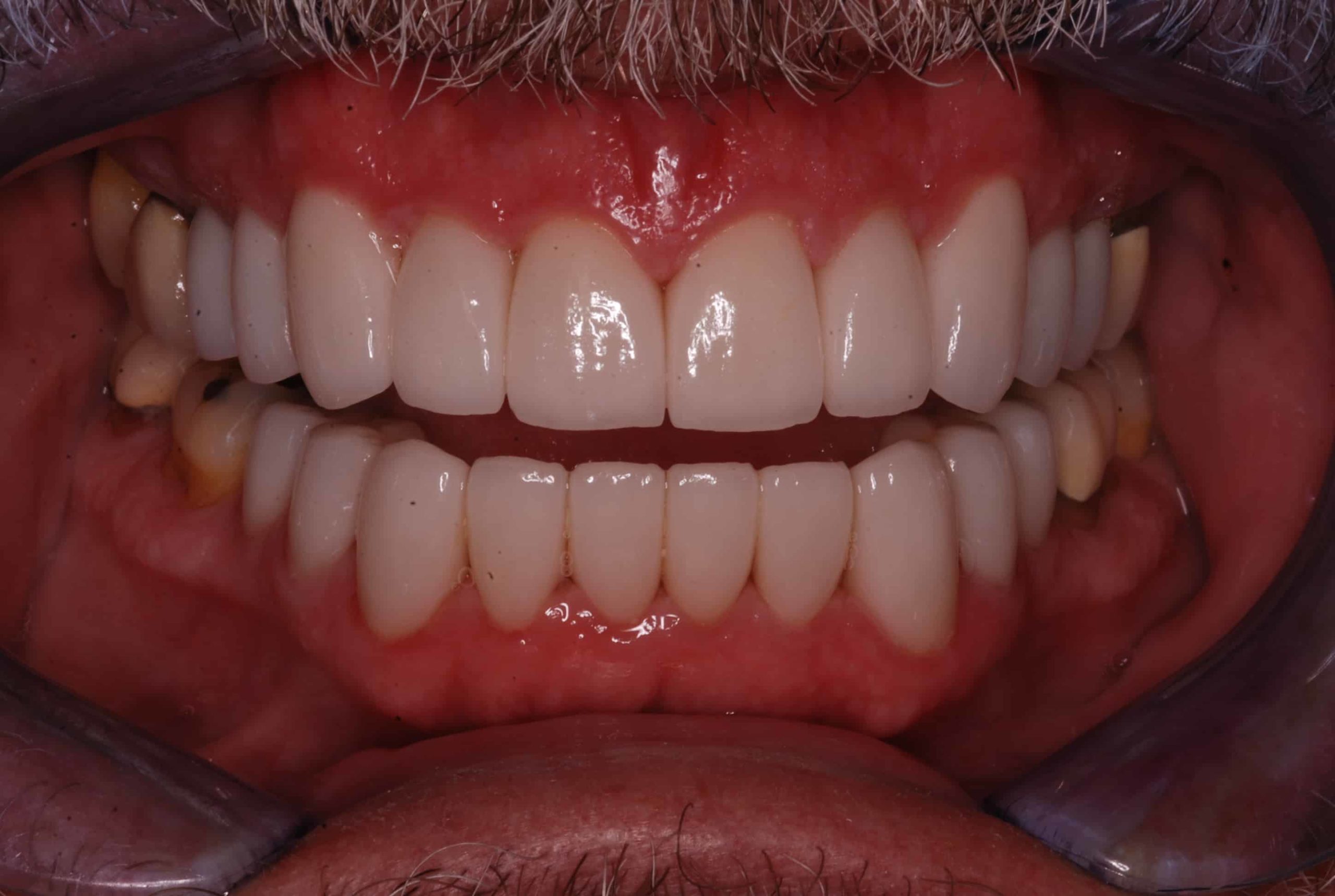 Cosmetic Dental Veneers after1