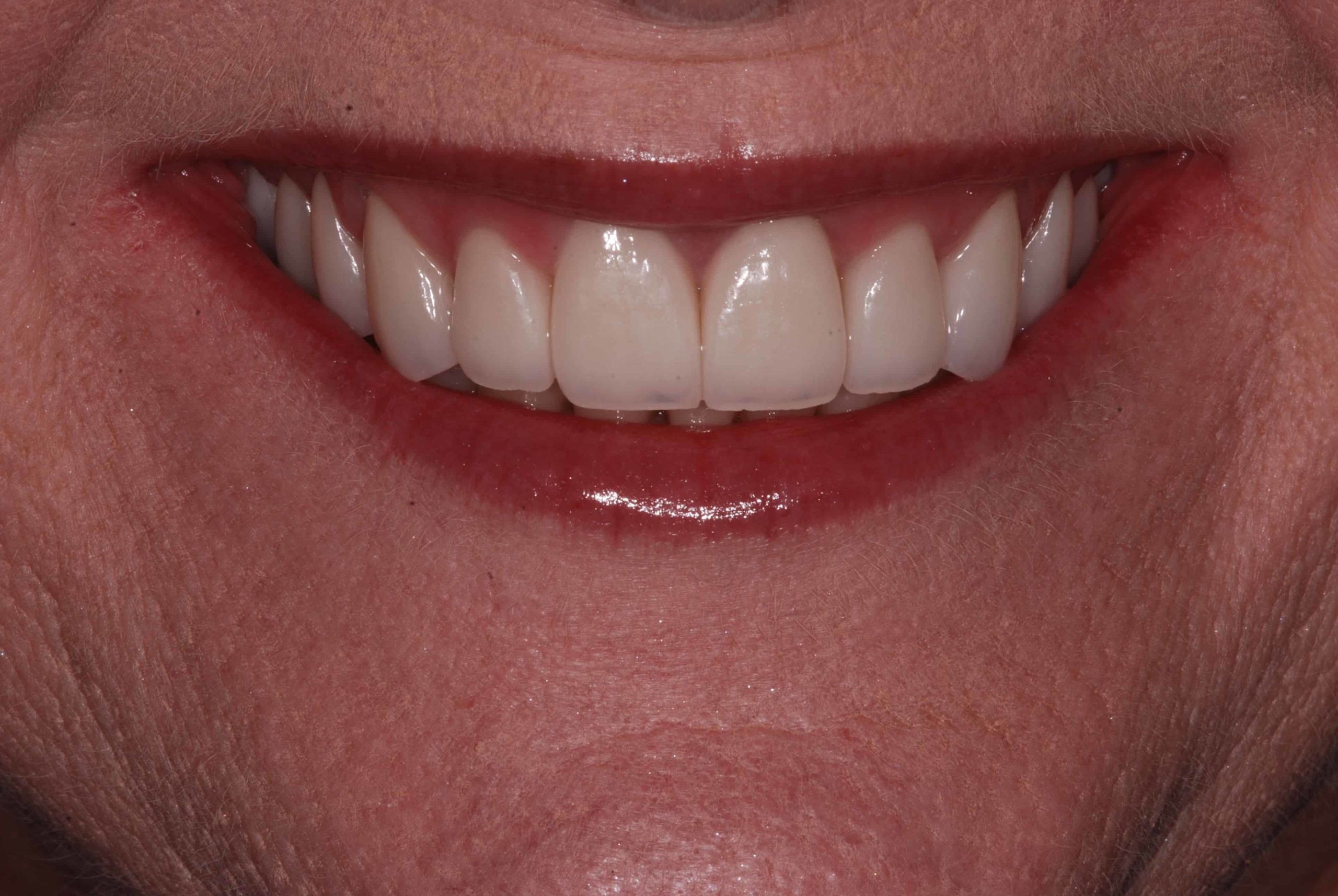 Cosmetic dental Veneers after 2