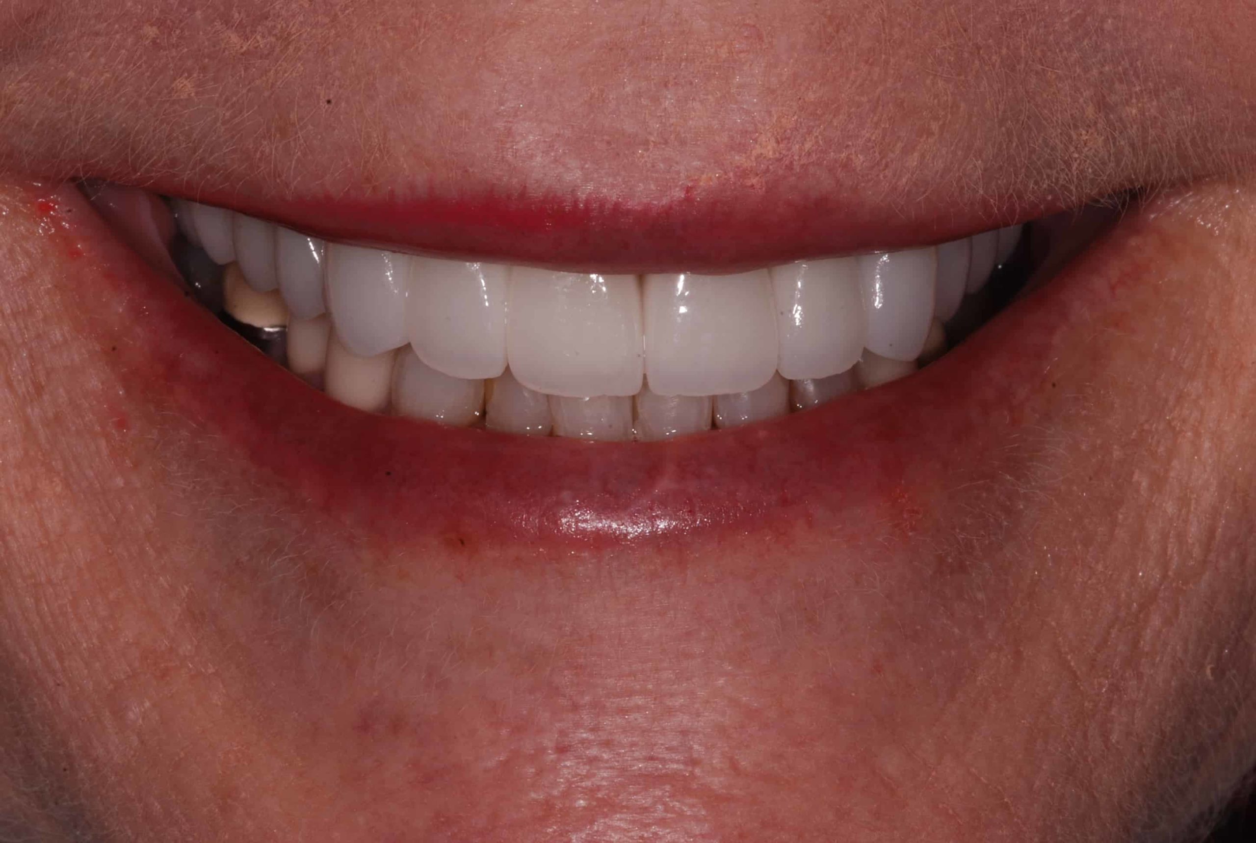 Cosmetic dental Veneers after 3