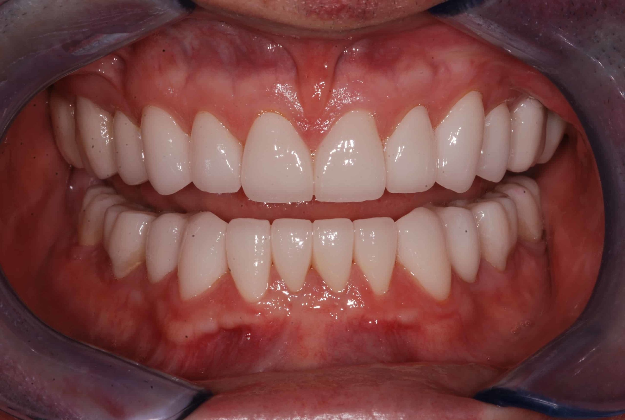 Cosmetic dental Veneers after 52