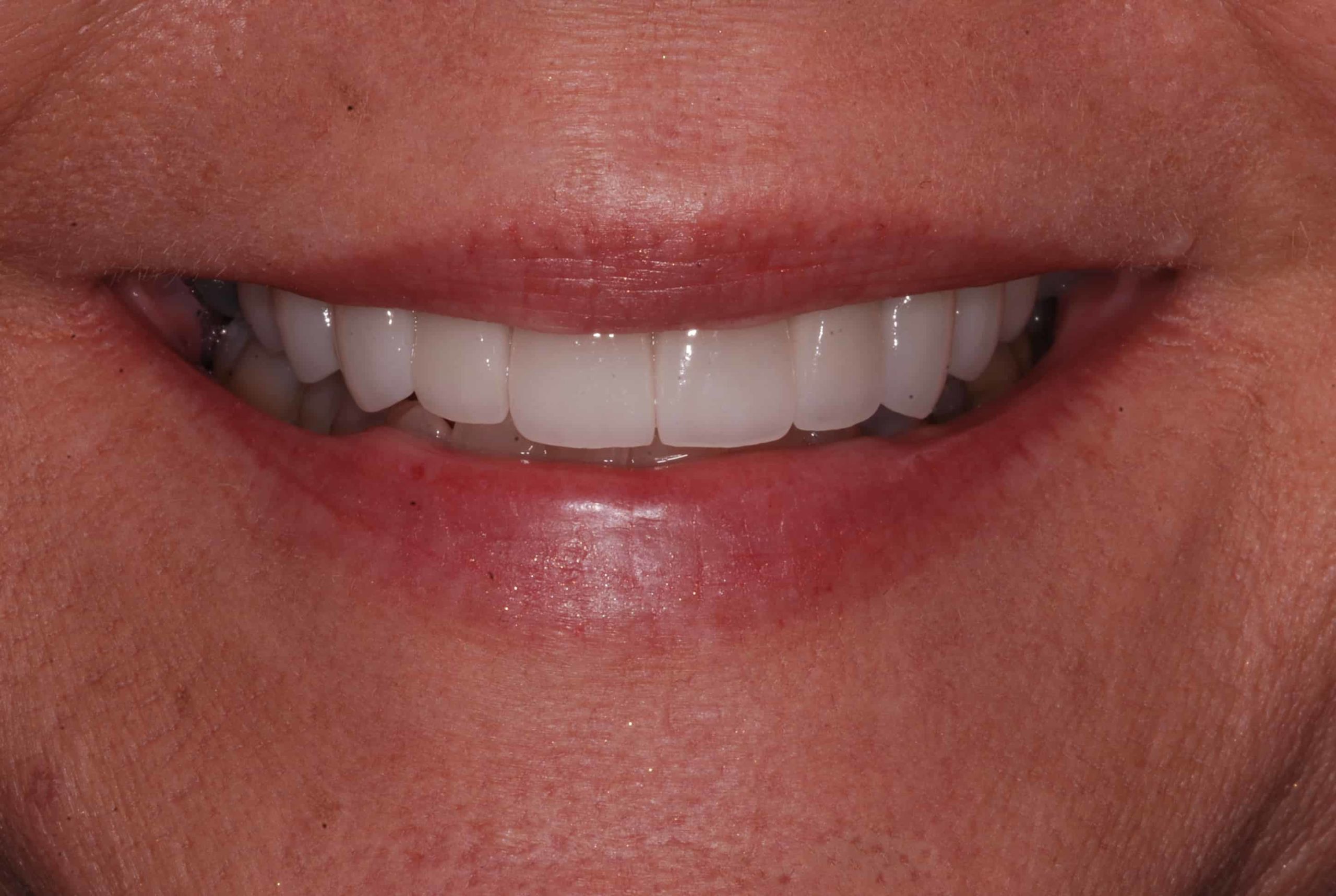 Cosmetic dental Veneers after 61