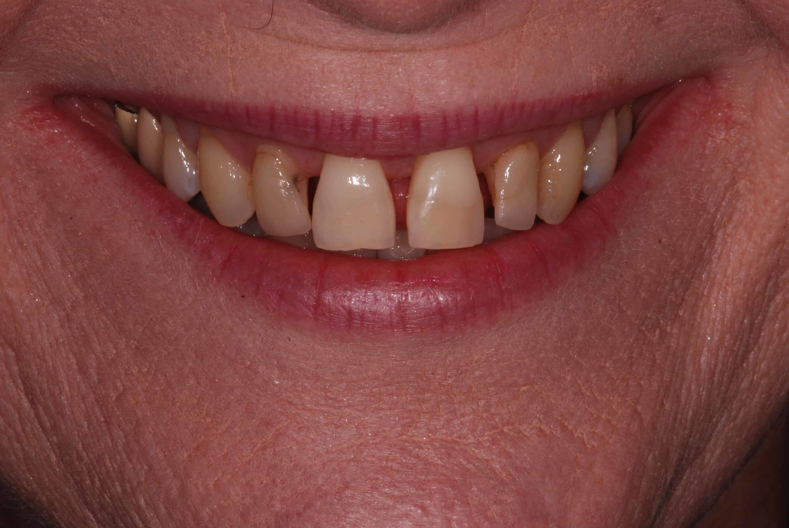 Cosmetic dental Veneers before 2