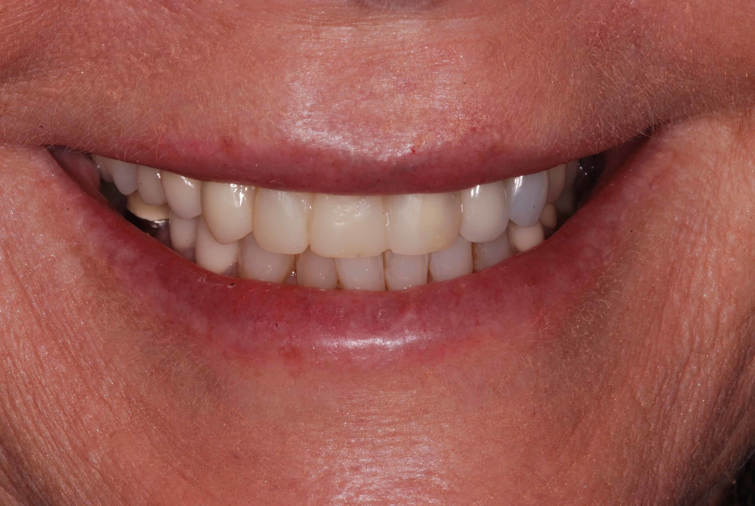 Cosmetic dental Veneers before 3