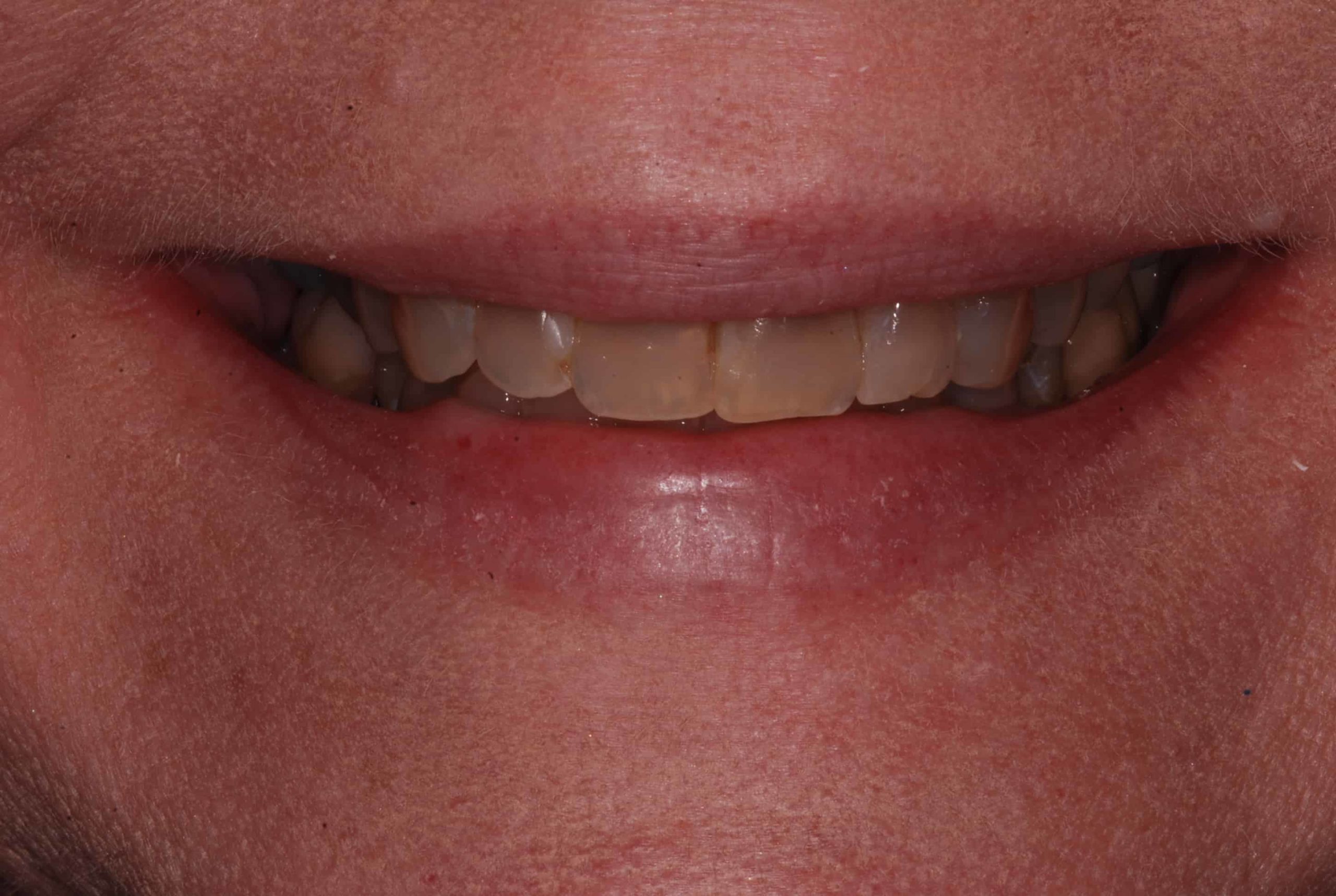 Cosmetic dental Veneers before 61