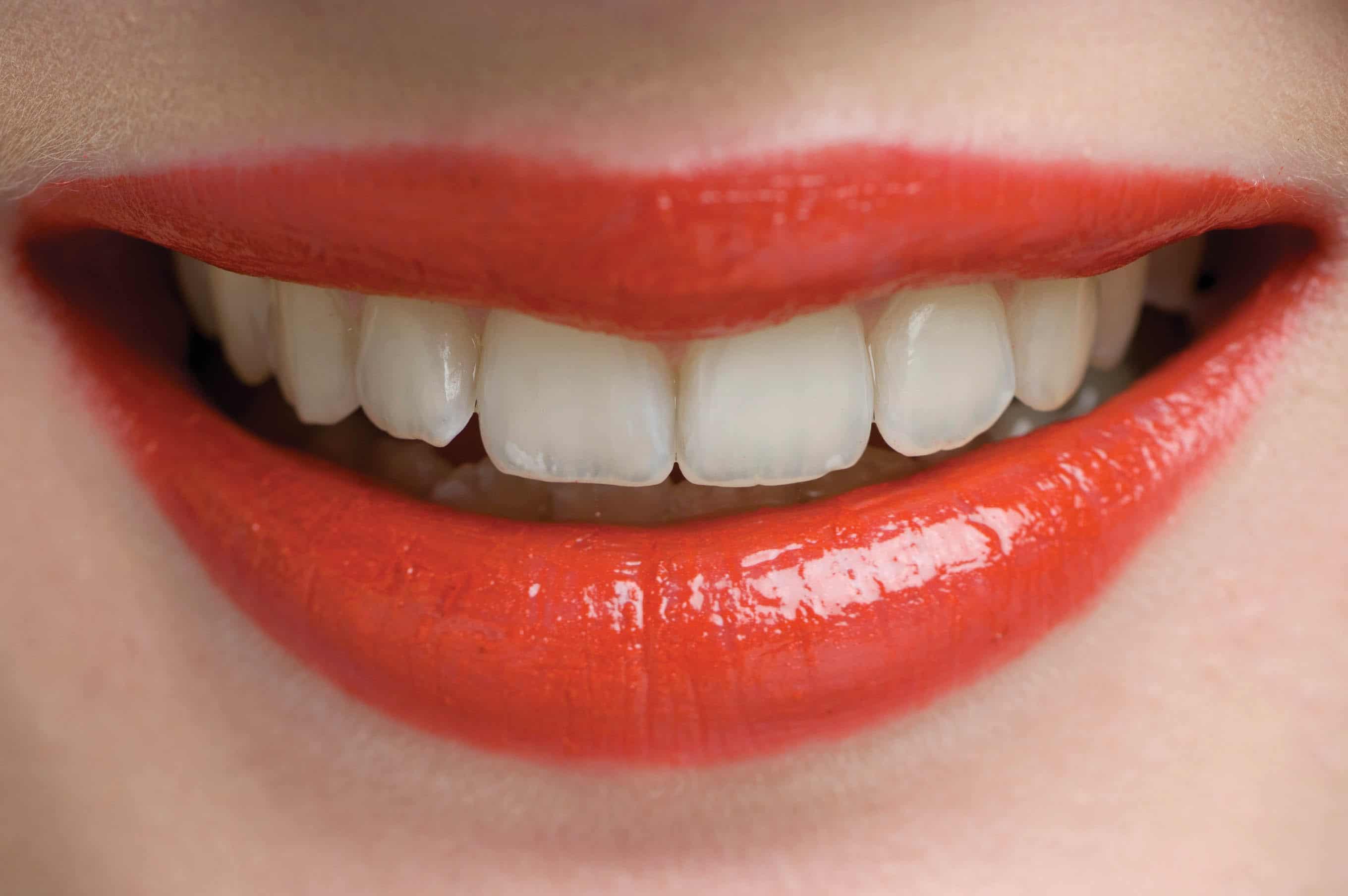 cosmetic porcelain veneers